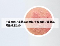牛皮癣破了皮第二天通红 牛皮癣破了皮第二天通红怎么办