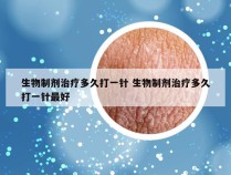 生物制剂治疗多久打一针 生物制剂治疗多久打一针最好