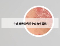 牛皮癣传染吗问中山南宁医院
