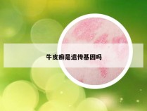 牛皮癣是遗传基因吗