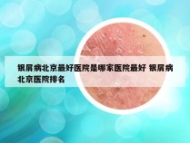 银屑病北京最好医院是哪家医院最好 银屑病北京医院排名