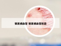 银屑病血管 银屑病血管形态