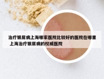 治疗银屑病上海哪家医院比较好的医院在哪里 上海治疗银屑病的权威医院