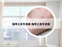 指甲上长牛皮癣 指甲上有牛皮癣
