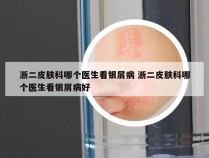 浙二皮肤科哪个医生看银屑病 浙二皮肤科哪个医生看银屑病好
