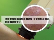 寻常型银屑病治疗周期轻度 寻常型银屑病治疗周期轻度变化