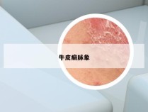牛皮癣脉象