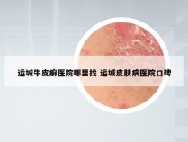 运城牛皮癣医院哪里找 运城皮肤病医院口碑