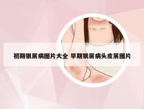 初期银屑病图片大全 早期银屑病头皮屑图片
