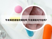 牛皮癣患者能吃猪肚吗 牛皮癣能吃牛肚吗?
