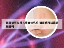 银屑病可以摸儿童身体乳吗 银屑病可以涂润肤乳吗