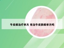 牛皮癣治疗单方 有治牛皮肤癣单方吗