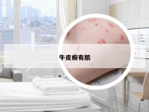 牛皮癣有脓