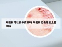 喝姜粉可以去牛皮癣吗 喝姜粉能去除脸上色斑吗