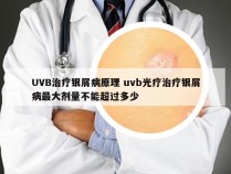 UVB治疗银屑病原理 uvb光疗治疗银屑病最大剂量不能超过多少