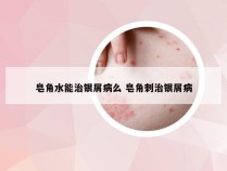 皂角水能治银屑病么 皂角刺治银屑病