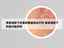 银屑病留下的黑斑要继续治疗吗 银屑病留下的黑印能好吗