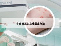 牛皮癣怎么止痒最土办法