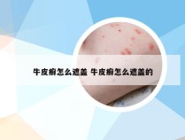 牛皮癣怎么遮盖 牛皮癣怎么遮盖的