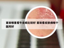 莆田哪里看牛皮癣比较好 莆田看皮肤病哪个医院好