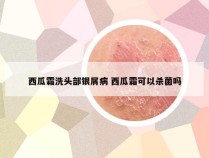 西瓜霜洗头部银屑病 西瓜霜可以杀菌吗