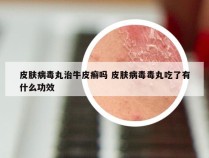 皮肤病毒丸治牛皮癣吗 皮肤病毒毒丸吃了有什么功效