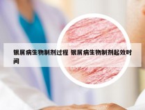 银屑病生物制剂过程 银屑病生物制剂起效时间