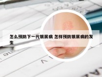 怎么预防下一代银屑病 怎样预防银屑病的发生
