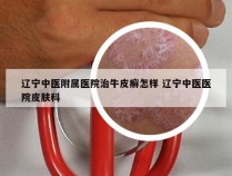 辽宁中医附属医院治牛皮癣怎样 辽宁中医医院皮肤科