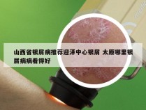 山西省银屑病推荐迎泽中心银屑 太原哪里银屑病病看得好