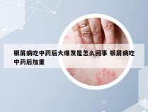 银屑病吃中药后大爆发是怎么回事 银屑病吃中药后加重
