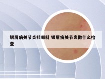 银屑病关节炎挂哪科 银屑病关节炎做什么检查