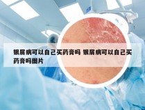 银屑病可以自己买药膏吗 银屑病可以自己买药膏吗图片