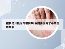 跑步出汗能治疗银屑病 我跑步治好了寻常型银屑病