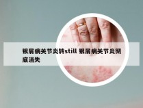 银屑病关节炎转still 银屑病关节炎彻底消失