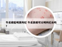 牛皮癣能喝黑枸杞 牛皮肤癣可以喝枸杞水吗?