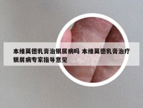 本维莫德乳膏治银屑病吗 本维莫德乳膏治疗银屑病专家指导意见