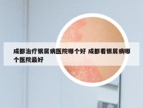 成都治疗银屑病医院哪个好 成都看银屑病哪个医院最好
