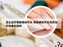 怎么治疗银屑病关节炎 银屑病关节炎怎样治疗效果比较好