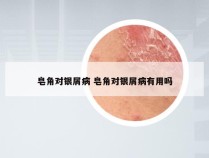 皂角对银屑病 皂角对银屑病有用吗