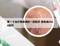 第一个治疗银屑病的一类新药 银屑病2020新药