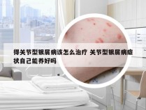 得关节型银屑病该怎么治疗 关节型银屑病症状自己能养好吗