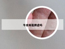牛皮癣是脾虚吗