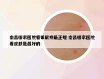 南昌哪家医院看银屑病最正规 南昌哪家医院看皮肤是最好的