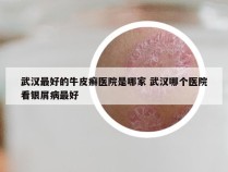 武汉最好的牛皮癣医院是哪家 武汉哪个医院看银屑病最好