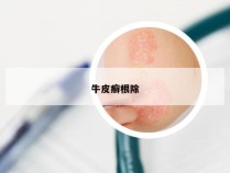牛皮癣根除