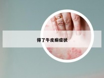 得了牛皮癣症状