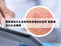 银屑病为什么会有鸡皮疙瘩似的皮疹 银屑病为什么会瘙痒