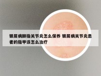 银屑病脚指关节炎怎么保养 银屑病关节炎患者的指甲该怎么治疗