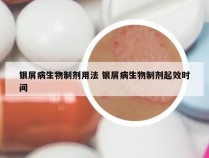 银屑病生物制剂用法 银屑病生物制剂起效时间